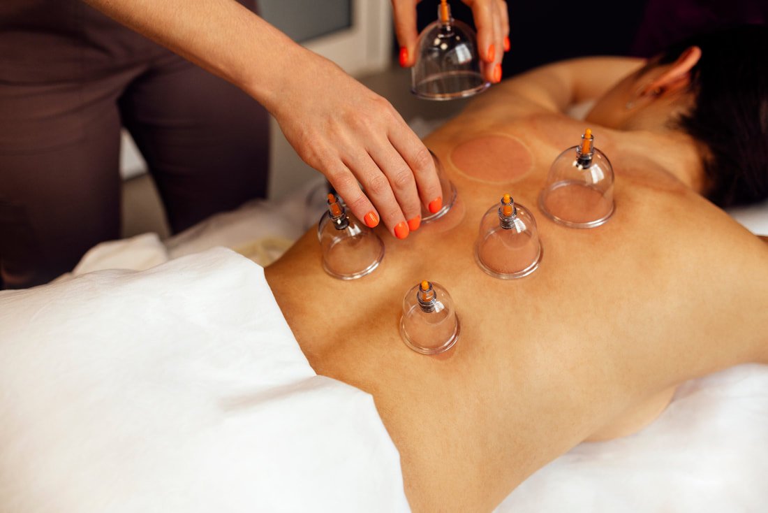 CUPPING