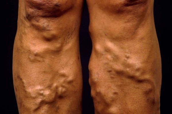 Varicose veins. Enlarged, superficial (saphenous) veins seen on a woman's legs below the knee. The condition is one of distended, lengthened and tortuous veins, most commonly affecting the legs of elderly women. The cause is the weakening of valves in these veins causing abnormal blood flow; valves normally prevent blood from draining back down the leg under the force of gravity. Contribu- ting factors include obesity, hormonal changes at pregnancy and menopause, and standing for long periods of time. Varicose veins may also be an inherited condition. Treatment is with elastic support stockings, regular walking & sitting with feet up. In severe cases surgery may be required.